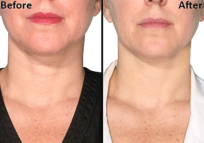 [Australia] - PHCOMRICH Anti Wrinkle Silicone Neck Pads,Resuable and 100% Medical Grade Décolleté Anti Wrinkle Patches Wrinkles Remover for Eliminatinb and Preventing Neck Wrinkles(2pcs) 
