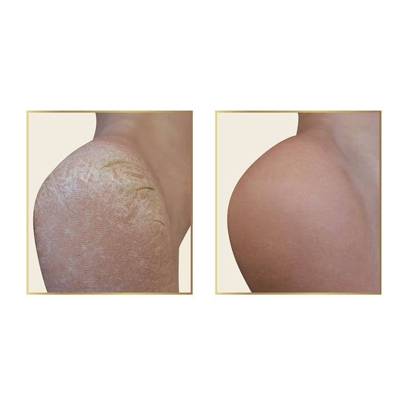 [Australia] - Simon&Tom Callus Remover - Exfoliating Peeling Gel 100 ml - Removes Hardness and Improves Cracked Heels - with Aloe Vera and Organic Argan Oil - Free of Parabens - Includes Nail File - Made in Spain 