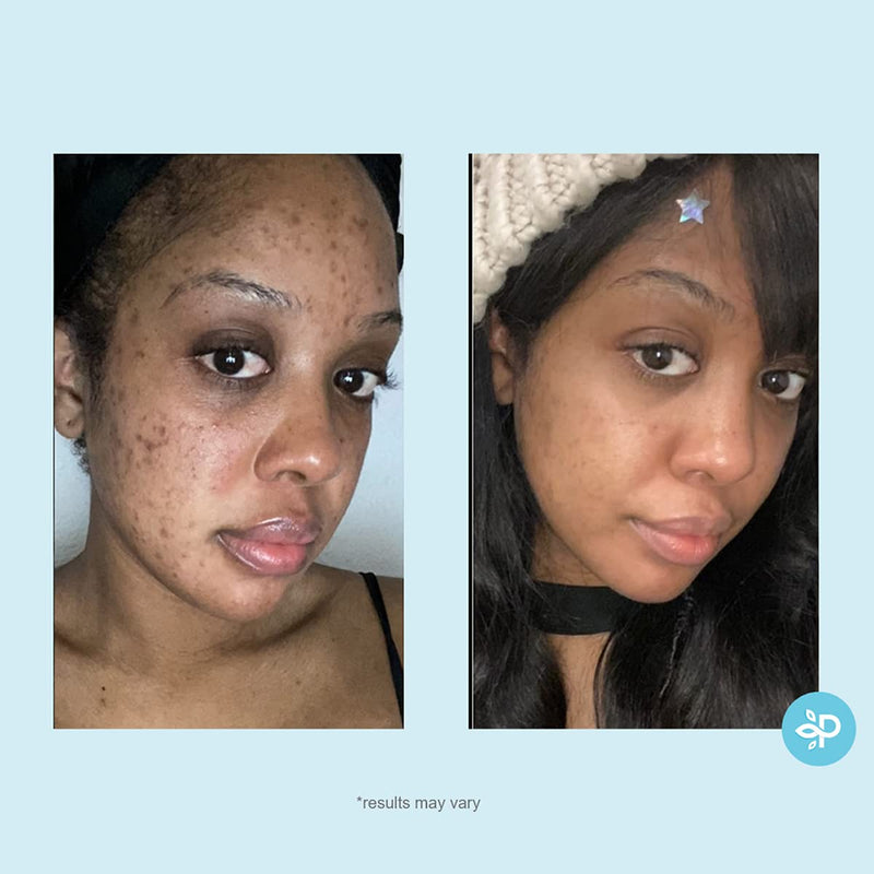 [Australia] - Salicylic 10% Gel Peel, Breakout and Pore Minimizer and Cleanser, 15-30 Full Facial Chemical Peels, 1 fl oz. e, 30 mL – Perfect Image 