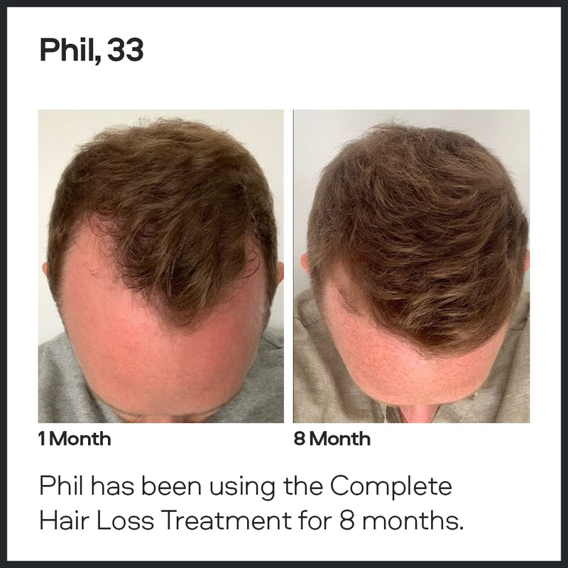 [Australia] - Sons Complete Hair Loss Treatment 1 Month - Minoxidil, Biotin & Shampoo - Boosts Thick Hair Regrowth 
