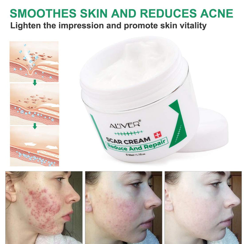 [Australia] - Scar Removal Cream for New Scars, Scar Treatment for Stretch Mark, Skin Repair Cream for Face Body Scar, Acne Spots, C-Sections, Burn, Acne, Stretch Marks 