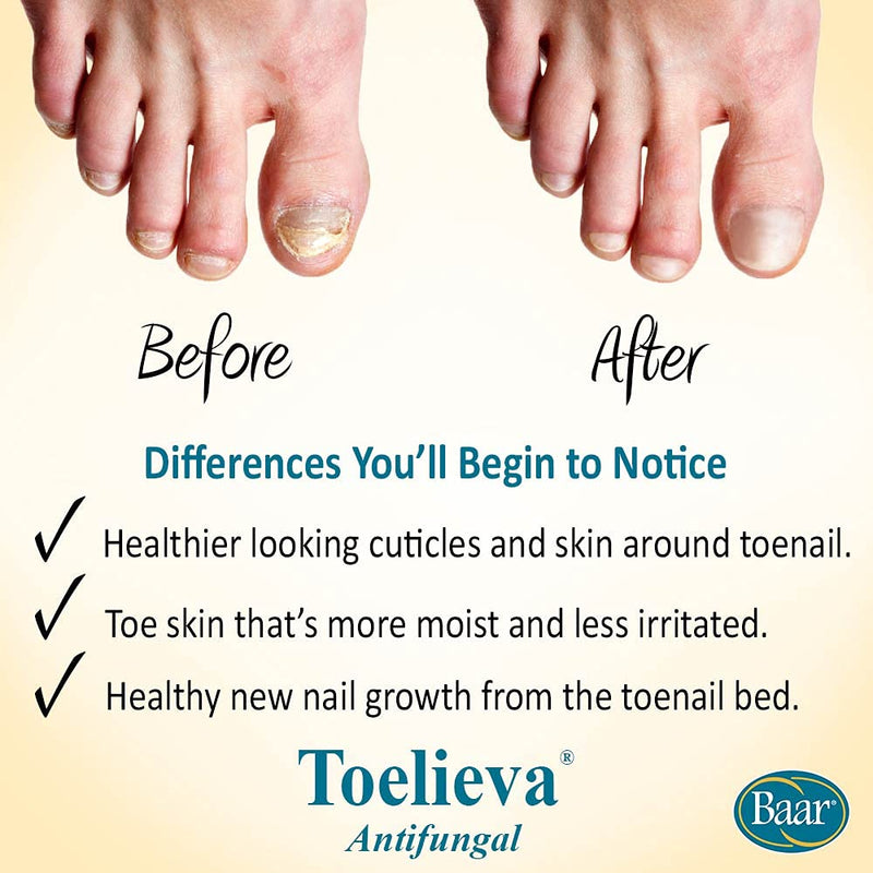 [Australia] - Toelieva Antifungal with Maximum Undecylenic Acid Fights Fungus Under/Around Toenails – 2 oz. 
