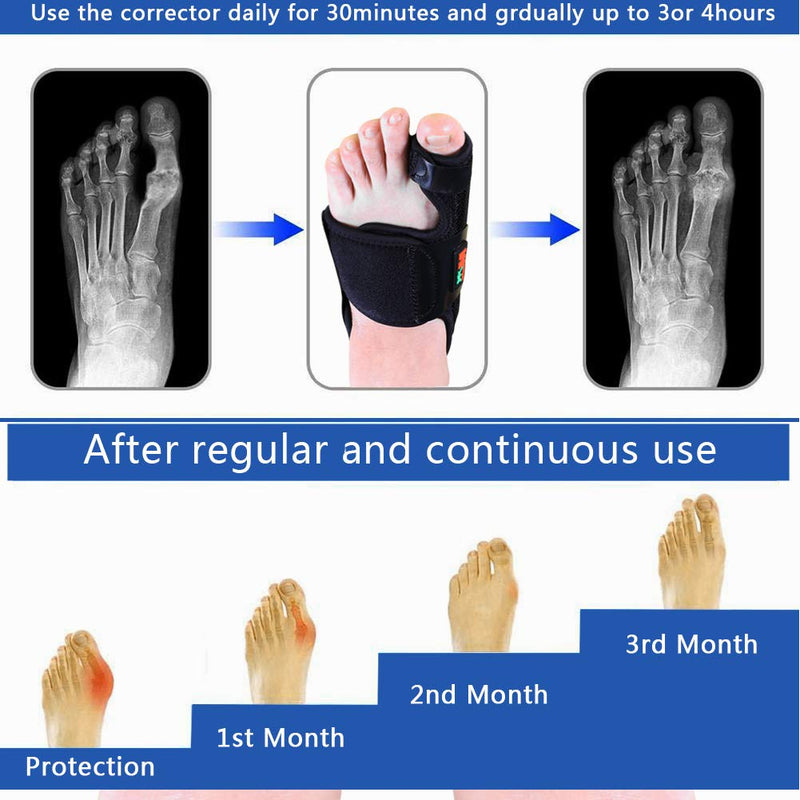 [Australia] - DAUERHAFT Adjustable Bunion Corrector Adjustable Strap Bunion Device Hallux Comfort Hallux Valgus Corrector,Orthopedic,Toe Foot(black, M code) Black, M Code 