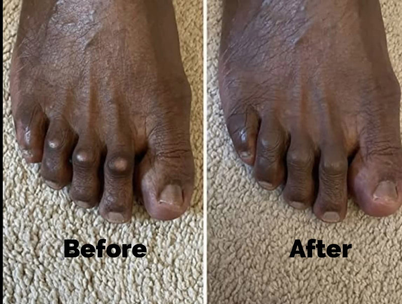 [Australia] - CORN-CEALER | Toe Corn Concealer | Instantly Hide Toe Corns | Lightweight Concealer For Toe Corns | MOCHA 