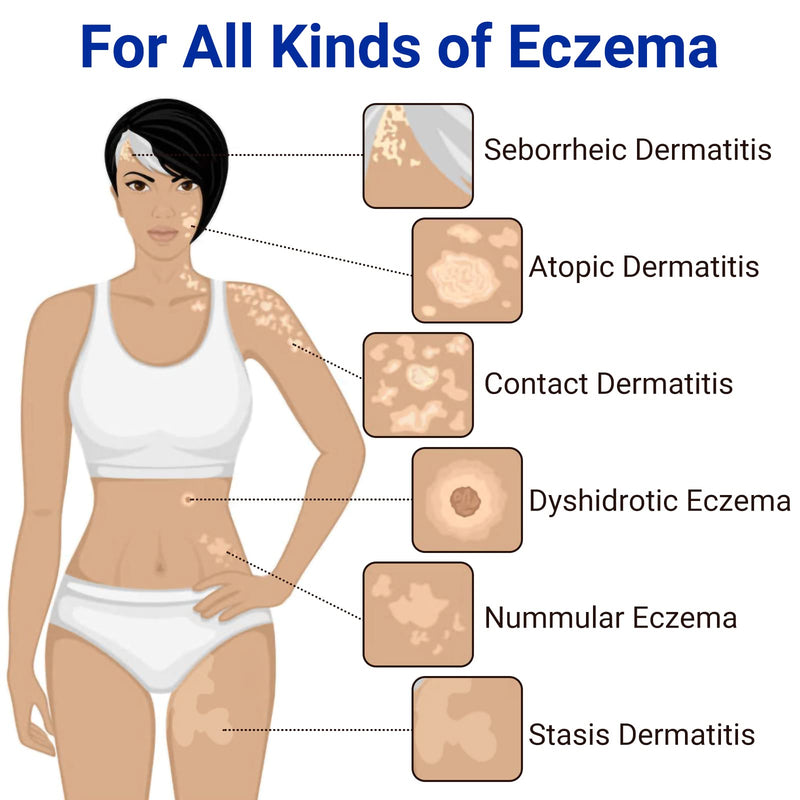 [Australia] - LMNOOP Eczema Cream for Dry, Itchy, Irritated, and Eczema Prone Skin, Maximum Strength Treatment Ointment for Rash, Psoriasis, Dermatitis, Beriberi (3.53oz) 3.53 Ounce 