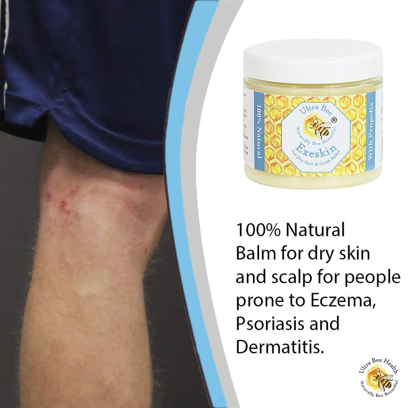 [Australia] - 100% Natural Exeskin Dry itchy Skin Balm suitable for People Prone to Eczema, Psoriasis,Dermatitis.Formulated with Beehive and Plant Products 100 ml 