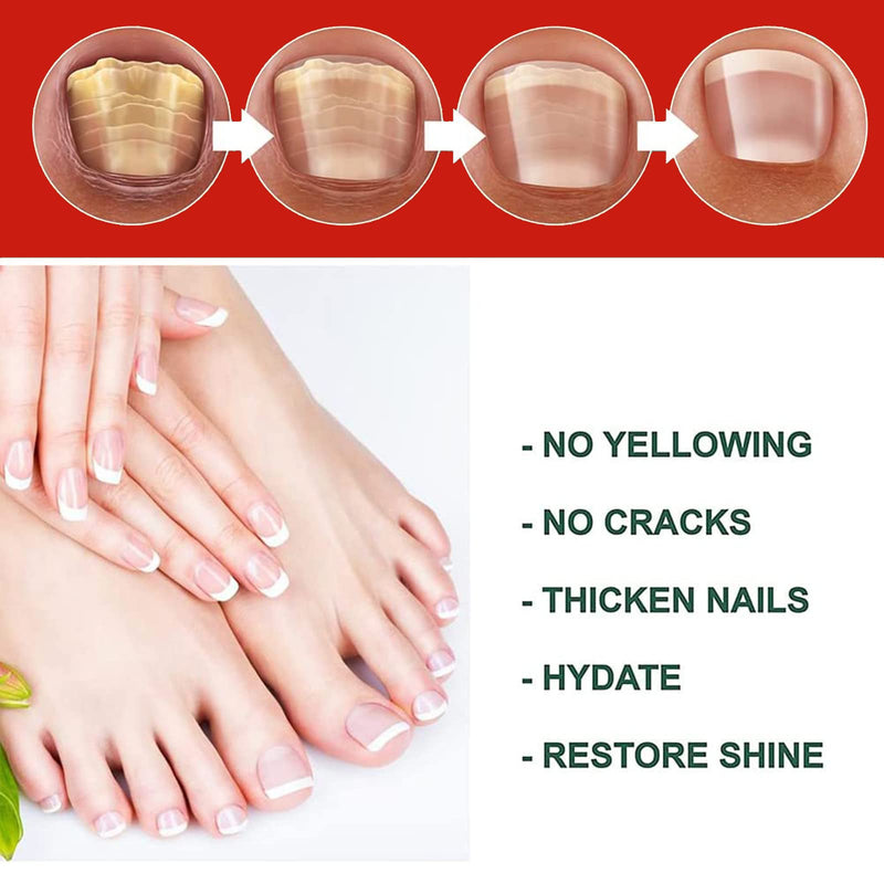 [Australia] - Nail Care Solution,Anti fungal Nail Solution,Nail Fungus Solution,Fungal nail,Nail Fungus Fungus Stop,Restores Appearance of Discolored 