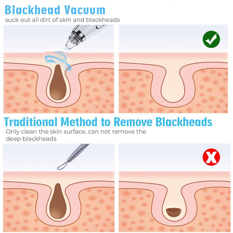 [Australia] - 2021 Newest Blackhead Remover Vacuum Pore Cleaner, Electric Acne Comedone Whitehead Extractor with 5 Suction Power & 5 Probes, USB Rechargeable, Blackhead Pore Vacuum for Women & Men Black 