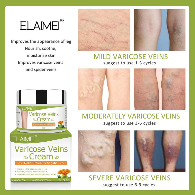 [Australia] - Varicose Veins Cream, Relief Phlebitis Angiitis Inflammation Blood Vein Veins Vasulitis Treatment Legs spider Veins, Improve Blood Circulation, Tired and Heavy Legs Fast Relief 