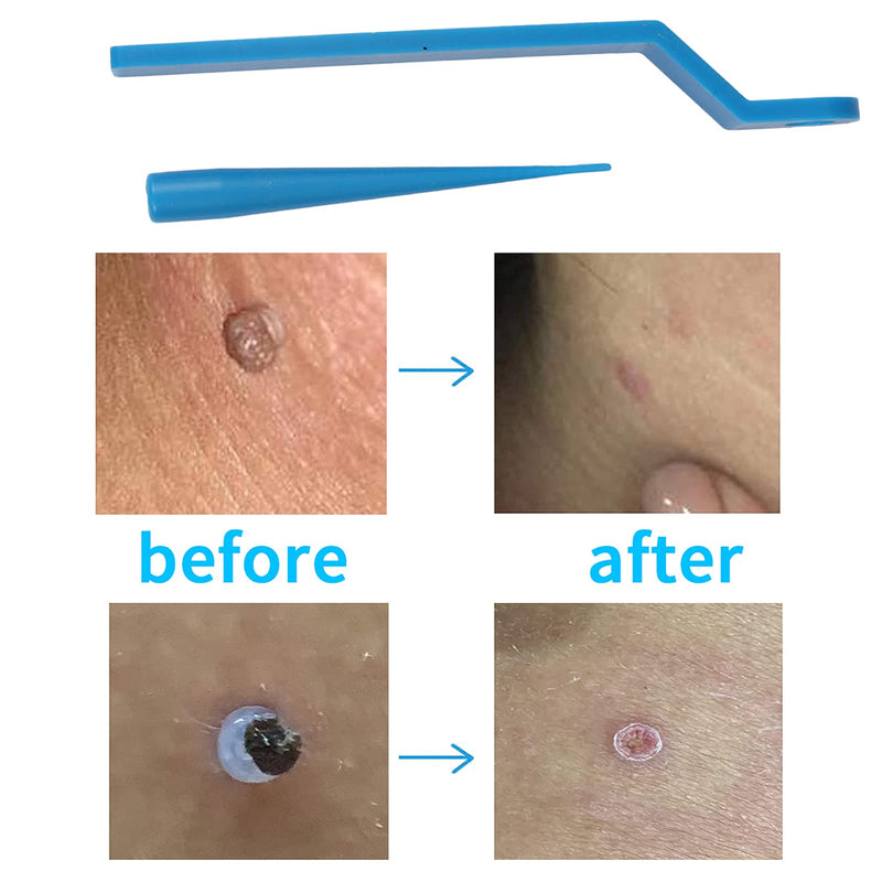 [Australia] - Rpanle Skin Tag Remover, Skin Tag Removal Kit with 20 Skin Tag Bands, Painless and Safe Remove Small to Large Sized (2mm to 4mm) Skin Tag 