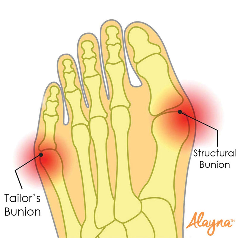 [Australia] - Alayna Bunion Corrector and Bunion Relief Sleeve Gel Pad Cushion Splint Orthopedic Bunion Protector for Men and Women, Hallux Valgus Corrector Bunion Guard, Bunion Pain Relief (2 PCS) (Large) 