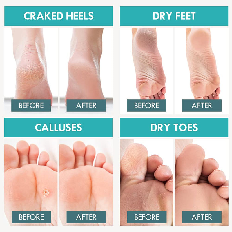 [Australia] - Foot Peel Mask | Dry & Cracked Feet Peeling Mask Exfoliator For Baby Soft Feet | Gentle Treatment Pedicure For Exfoliating Dry Feet 