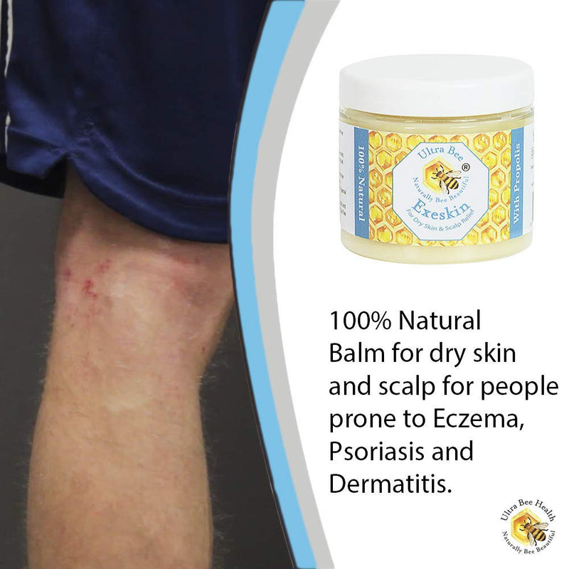 [Australia] - 100% Natural Exeskin Balm 200ml - Soothes Dry Sensitive Skin and Dry Itchy Scalp - Also Suitable for People Prone to Eczema Psoriasis, Dermatitis, Rosacea 