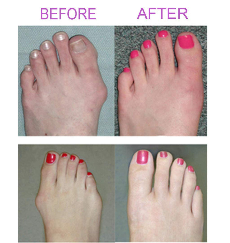 [Australia] - Bunion Corrector Relief Protector Sleeves, w/ 3 Hole Adjustable Slim Toe Straighteners Separators Corrector Brace 24h Day Night Splints Treat Pain Hallux Valgus Hammer Toe Joint Easy Wear in Shoes (S) S 