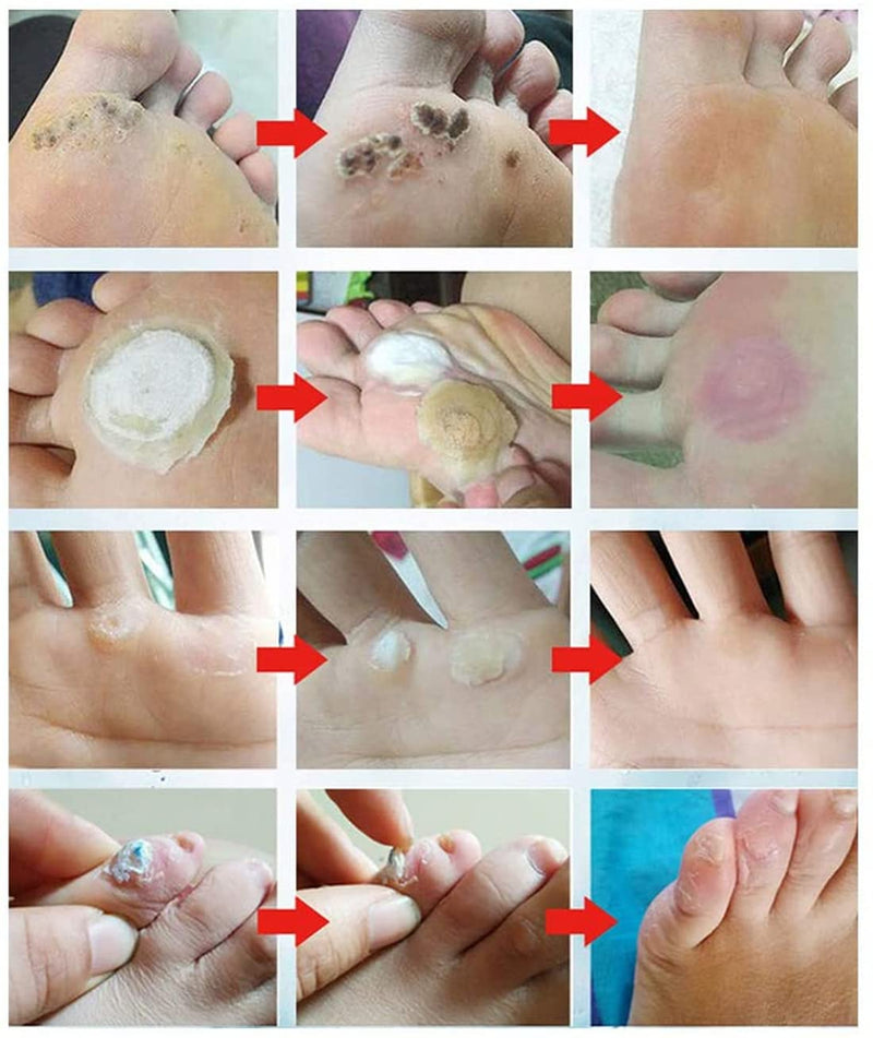 [Australia] - MYMULIKE Corn Removal Pads, Wart Remover, Corn Removal Plaster, Corn Removal Relief Corn Pain and Foot Care (24 Count) 24 Count (Pack of 1) 