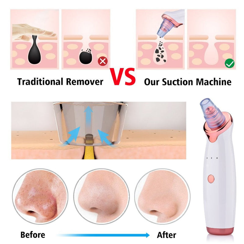 [Australia] - Aibeau Blackhead Remover Electric Blackhead Vacuum Suction Rechargeable Whitehead Remover Tool Kite Cleanser with 4 Replaceable Heads, Hot Pack Function and 3 Modes 