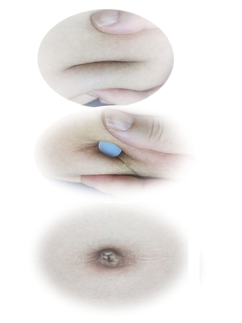 [Australia] - Soft Belly Button Plug Post Tummy Tuck（5PCS Different Sizes） Belly Button Marble Effect White 