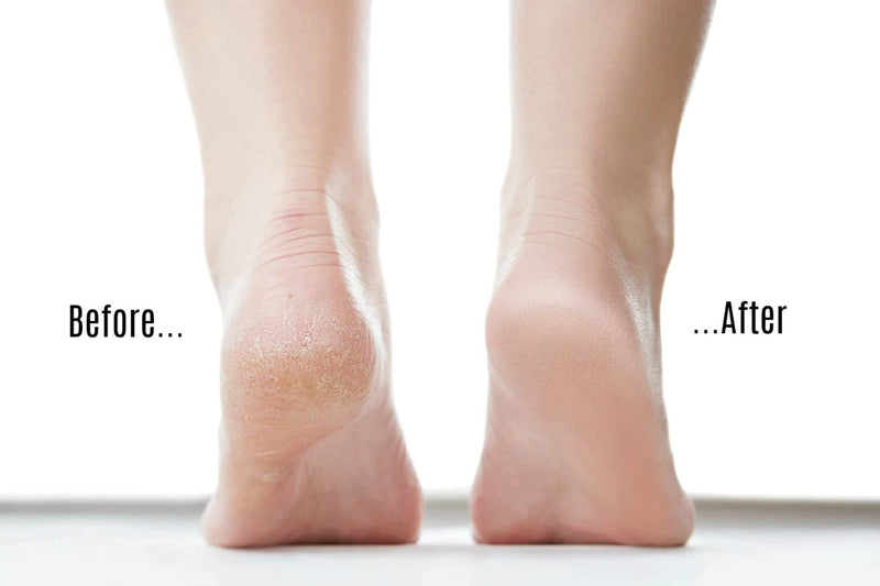 [Australia] - Skinapeel Large Pumice Stone - Natural Foot Care Scruber - Dead Hard Skin Callus Remover - Pedicure Tool - Skinapeel UK Skincare Specialists 