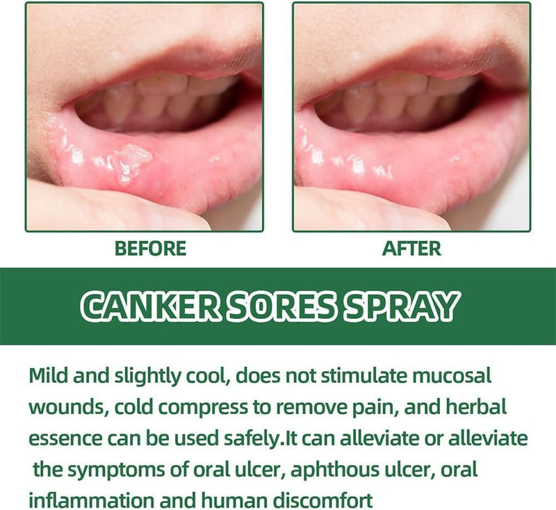 [Australia] - Ulcer Breath Sprays,Oral Ulcer Sprays,Antiviral Mouth Spray,Canker Relief Spray,Breath Spray for Bad Breath,Herbal Mouth Spray,Mouth Ulcer Sprays 20ML 