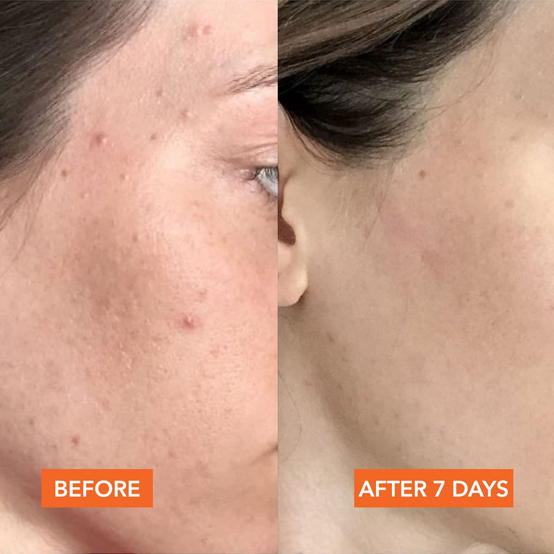[Australia] - Dr. Dennis Gross Alpha Beta Peel Universal Formula 5 x 2.2 ml 