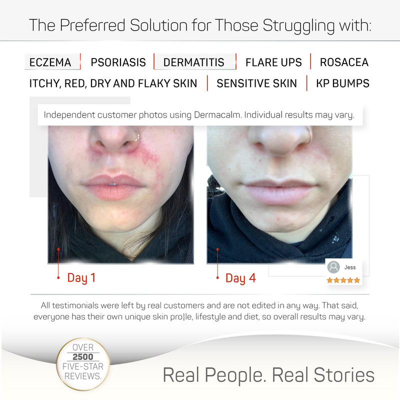 [Australia] - Clinically Tested Cream for Eczema, Dermatitis and Psoriasis Treatment - Urea 8%, Probiotics w/Best Natural Ingredients - Face & Body Lotion - Itchy, Severely Dry, Scaly Skin. Moisturizer 