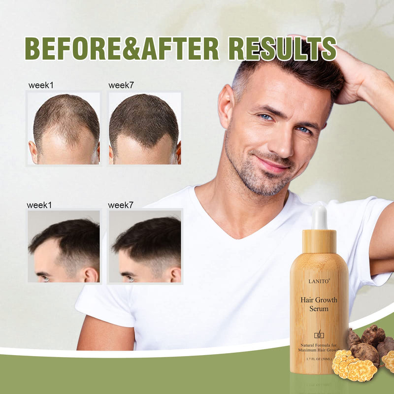 [Australia] - LANITO Hair Growth Serum with Radix Polygonum Multiflorum Root Extract for Hair Thinning, Hair Fall & Healthy, Scalp Hair Thickening Products for Woman Man 50 ML 1.69OZ 