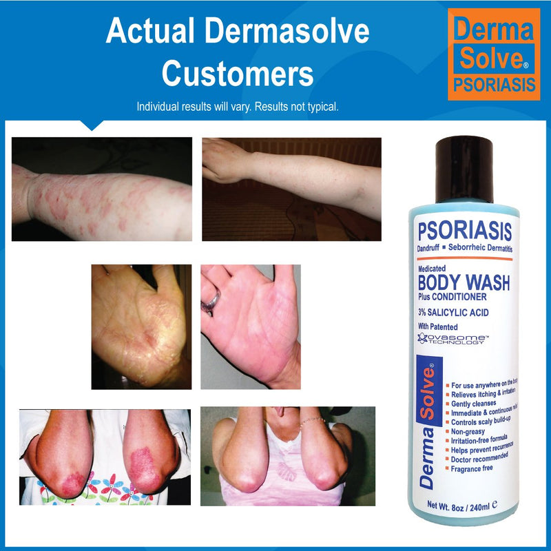 [Australia] - Psoriasis Body Wash by DermaSolve (2-Pack) | Psoriasis, Eczema, Seborrheic Dermatitis - Proven to Provide Relief from Dry Itchy Red Flaky Scaly and Inflamed Skin - Doctor Recommended (8.0 oz each) 