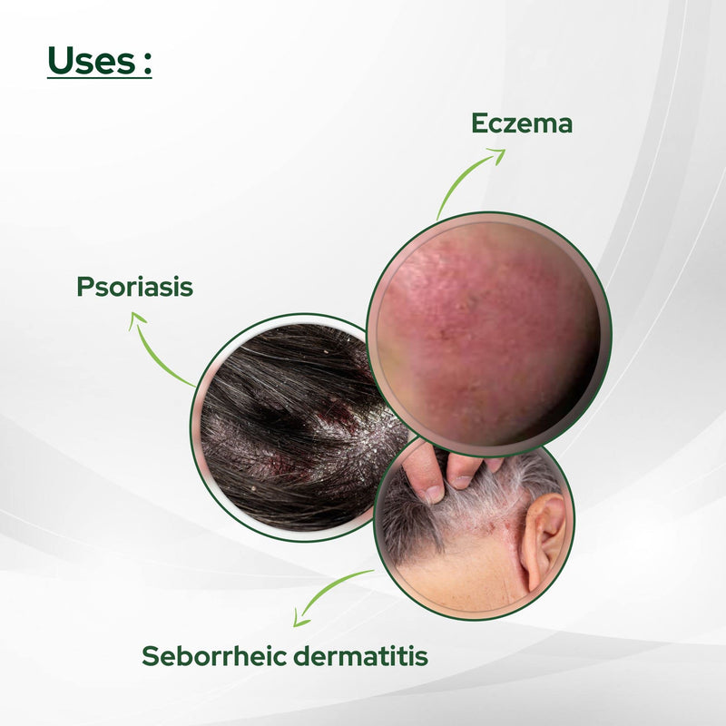 [Australia] - Psoriasis Coal Tar Salicylic Acid 100gm by SALVE 3.52 Ounce (Pack of 1) 