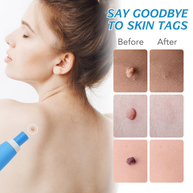 [Australia] - 2 in 1Skin Tag Removal,Skin Tag Remover Kit, Skin Tag Removal Pen Face Care Mole Wart Tool Patches,Fast Effective & Safe Painless 