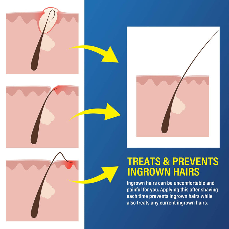 [Australia] - Razor Bump and Ingrown Hairs Serum - After Shave Solution Roll-On for Ingrown Hairs, Razor Burns and Razor Bumps for Men and Women 