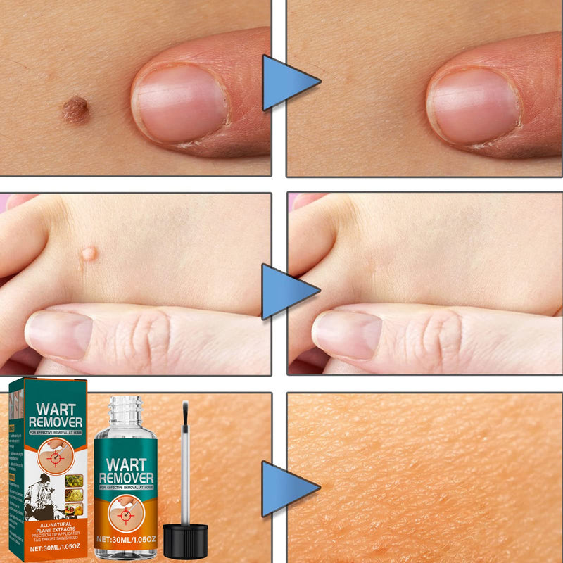 [Australia] - Skin-Tag-Removal,Fast-Acting Skin Wart Removal,Skin Tag Remover Liquid,Safe and Fast-Acting Skin Tag Remover,Natural Wart Remover for All Skin Types,30ml 