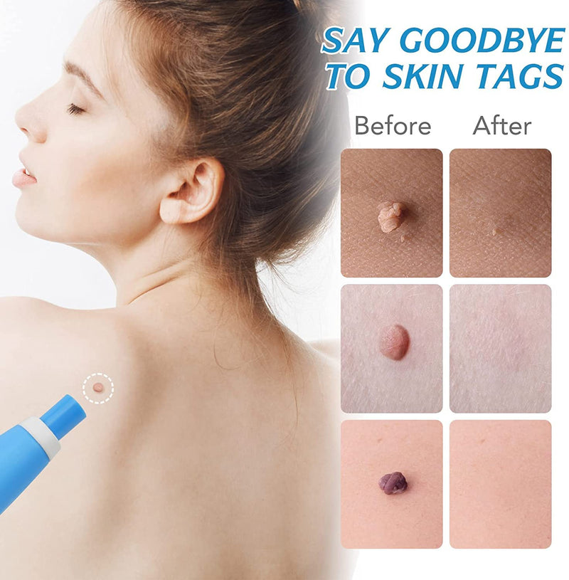 [Australia] - 2 in 1 Skin Tag Remover Kit, (2mm to 8mm) Skin Tag & Moles Removal Kit, Auto Skin Tag Remover Pen, Painless Skin Tag Mole Wart Removal Kit for All Body Parts (A) A 