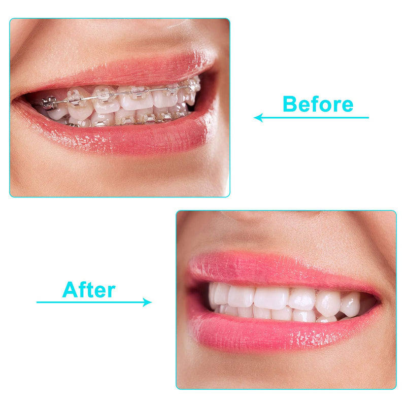 [Australia] - 20 Pieces Aligner Tray Seaters Chewies for Aligner Trays Chompers Aligner Trays (Pink, Orange, Green, Purple, White) Pink, Orange, Green, Purple, White 