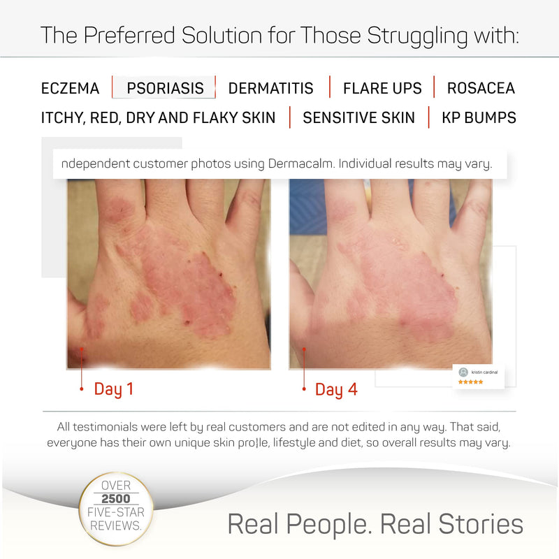 [Australia] - Clinically Tested Cream for Eczema, Dermatitis and Psoriasis Treatment - Urea 8%, Probiotics w/Best Natural Ingredients - Face & Body Lotion - Itchy, Severely Dry, Scaly Skin. Moisturizer 