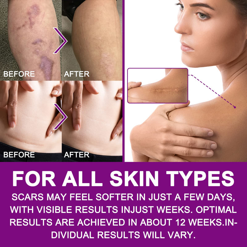 [Australia] - Silicone Scar Tape for Scar Treatment, Advanced Scar Removal Sheets, Soften and Flatten Old Scars and New Scars Which Resulting from Surgery, Acne, Injury, Burns, C-Section and More (4cm x 1.5m) 