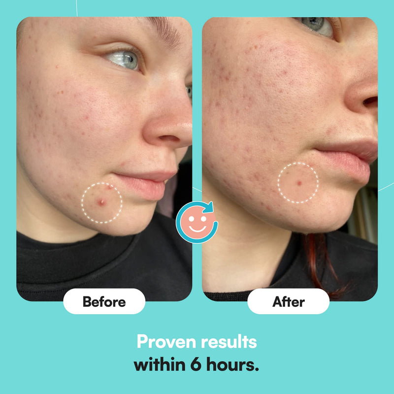 [Australia] - Breakout Pimple Acne Spot Patches by SKINCHOICE - 30 Invisible Hydrocolloid Mighty Patch, Dots for Blemish Spots Treatment For Face, Zit Stickers, Vegan & Cruelty-Free Skin Care 30 Count (Pack of 1) 