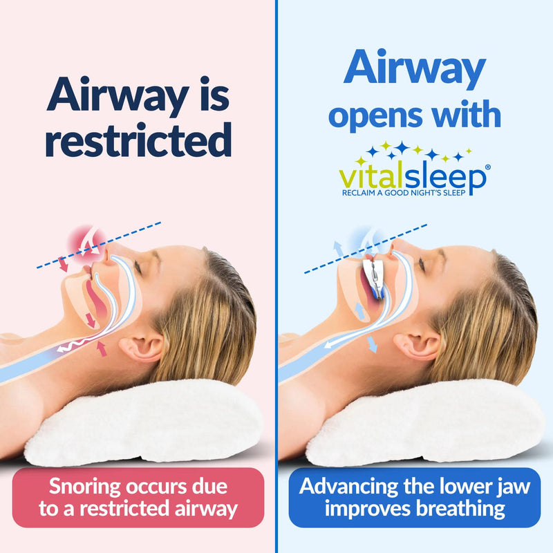 [Australia] - VitalSleep Anti-Snoring Mouthpiece Small, Women's Size Snoring Solution, Adjustable Jaw Positioning, Personalized Teeth Impressions, USA Made & FDA Cleared Stop Snoring Mouth Guard 