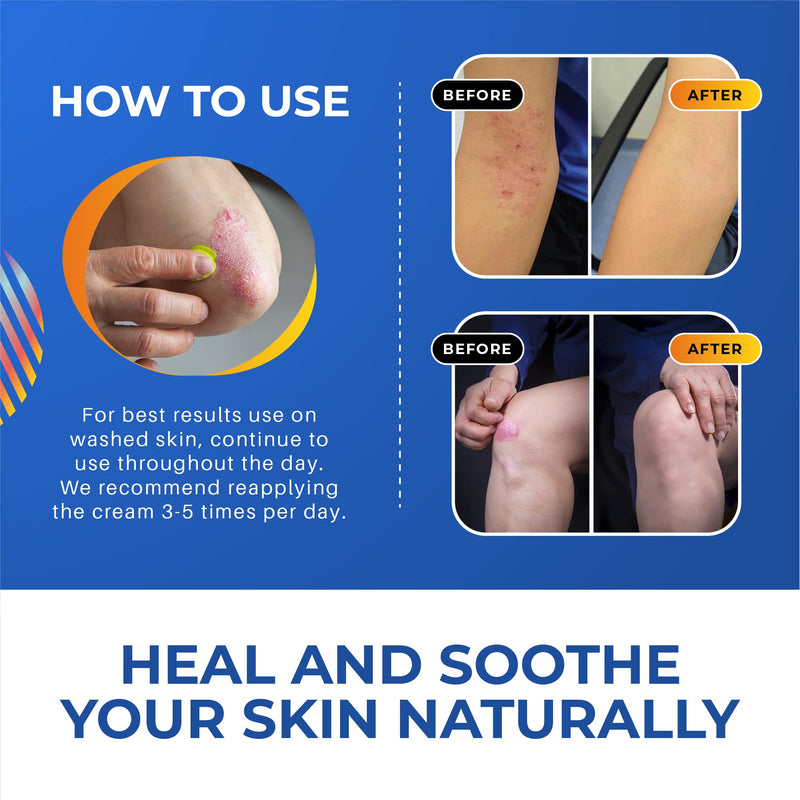 [Australia] - Anti Fungal Skin Cream | Anti Itch Cream | Jock Itch Treatment for Men and Women | Ringworm Treatment | Natural Eczema Treatment | 50g 