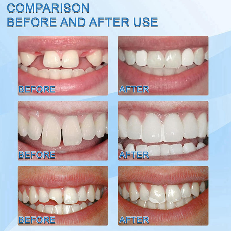 [Australia] - Temporary Tooth Filling, Thermal Forming False Teeth, Tooth Repair Kit DIY Moldable Fake Teeth Repair Beads for Temporary Fixing, Dental Tooth Filler for Missing Broken Fake Chipped Teeth (30ml) 