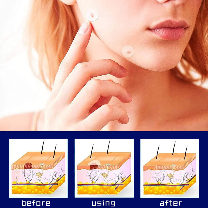 [Australia] - Skin Tag Removal Patches,Mole Removal Patches,Wart Removal Sticker,Spot Removal Stickers,Fast-Acting for Different Size of Warts,180pcs 