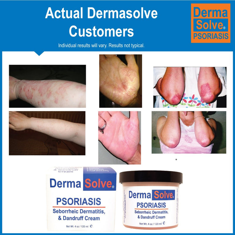 [Australia] - Extra Strength Psoriasis Cream | Seborrheic Dermatitis & Dandruff Lotion - Advanced Moisturizing Relief Formulated to Treat Itchy Flakey Inflamed Skin & Prevent Future Flares - 4.0 oz. 4 Ounce (Pack of 1) 
