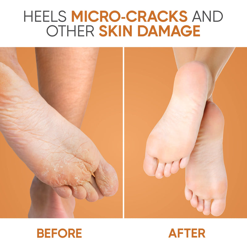 [Australia] - Heel Balm Stick Cracked Foot Repair Foot Cream For Dry Skin Heels Soothing Moisturizer Callus Remover For Dry Irritated Feet With Vitamin E Tea Tree Oil Foot Care Treatment For Women And Men 