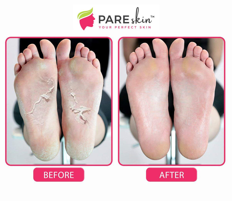 [Australia] - [ 2 Pack ] Foot Peel Mask - Cracked Heels Repair for Dry Callus Dead Skin - Exfoliating Peel Remover for Baby Soft Feet 