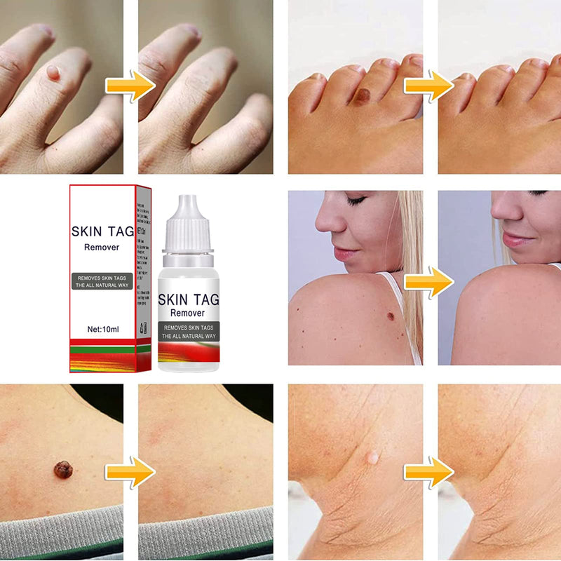 [Australia] - Wart Remover Liquid,Skin Tag Warts Foot Corn Removal,Foot Corn Removal Easy Application Suitable for Hands, Feet, Face and Body(10ml) 