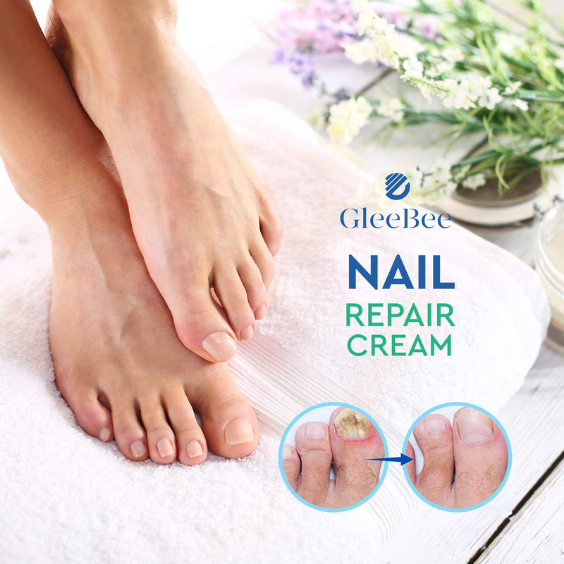 [Australia] - Fungal Nail Treatment, Fungus Nail Cream, Strong Anti-Fungal Toenail Cream, Nail Repair Nourishing Treatment, Restores Discolored and Damaged Nails 