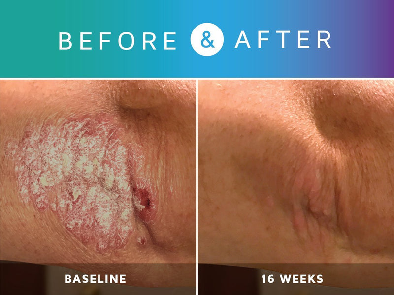 [Australia] - Prosoria Psoriasis Treatment System with Clinical Strength and Natural Botanical Ingredients - Treating, Softening and Restoring The Appearance of Skin, 2 Ounce 2 Fl Oz (Pack of 2) 