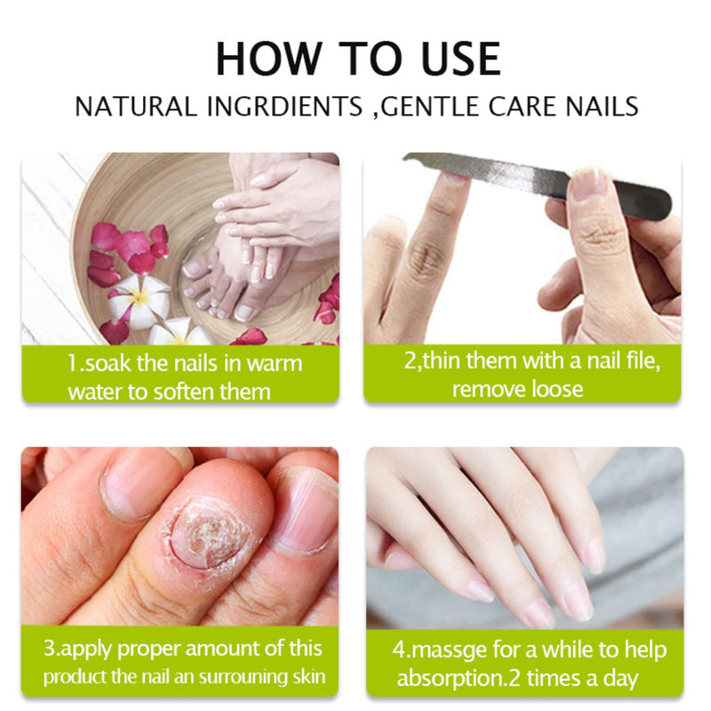 [Australia] - Fungal Nail Treatment, Fungus Nail Cream, Fungal Nail Eliminator for Toenails and Fingernails Strong Anti-Fungal Toenail Cream, Nail Repair Nourishing Treatment 