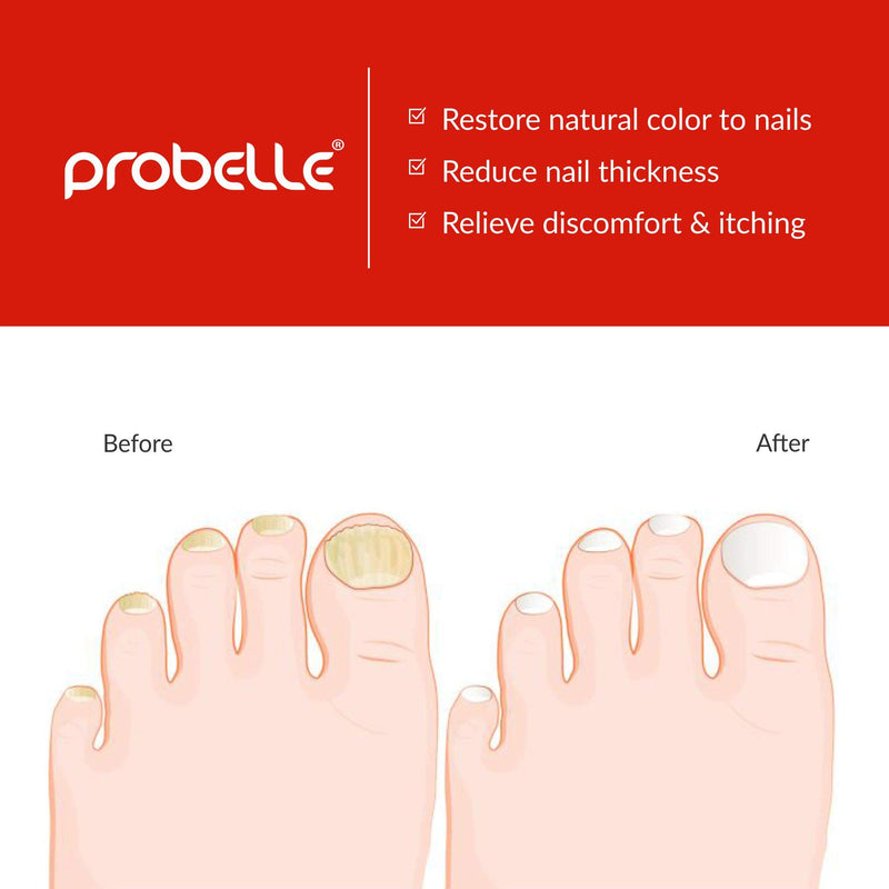 [Australia] - Probelle Natural Fungal Nail Treatment, Anti Fungal Nail Treatment, Nail Color Restoration, Clear Homeopathic Topical Solution .5 oz/ 15 ml (Patented Formula) 