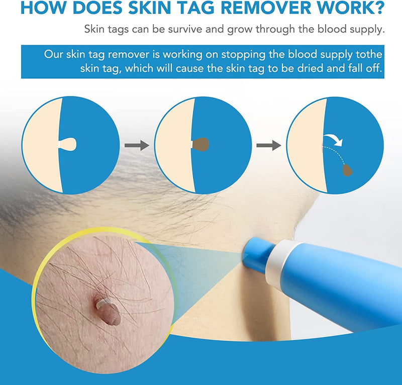 [Australia] - 2 in 1 Skin Tag Remover Kit, (2mm to 8mm) Skin Tag & Moles Removal Kit, Auto Skin Tag Remover Pen, Painless Skin Tag Mole Wart Removal Kit for All Body Parts (A) A 