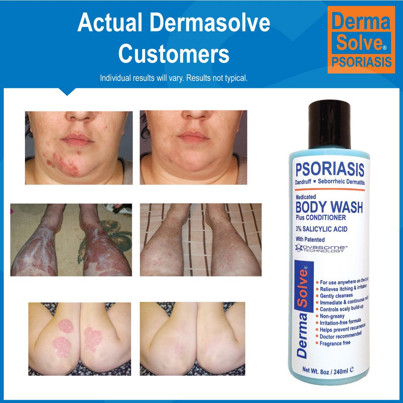 [Australia] - Psoriasis Body Wash by DermaSolve (2-Pack) | Psoriasis, Eczema, Seborrheic Dermatitis - Proven to Provide Relief from Dry Itchy Red Flaky Scaly and Inflamed Skin - Doctor Recommended (8.0 oz each) 